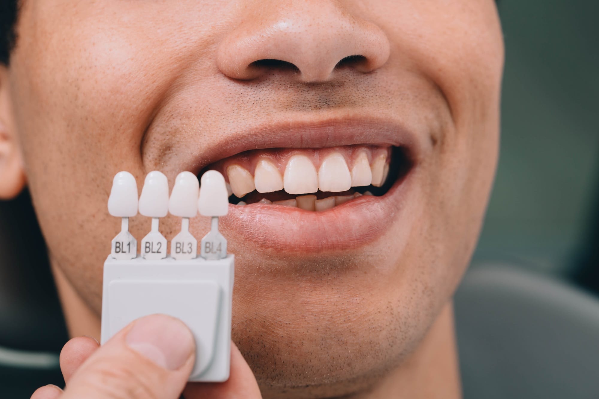 Dentist sampling shades teeth ,he holding teeth shades palette near male mouth. Whitening teeth