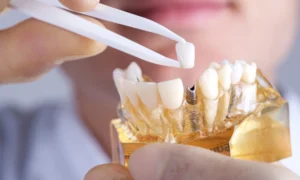 How Long Do Dental Implants Last