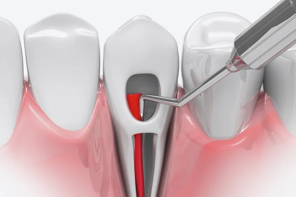 Root Canal - DENTIST NEAR YOU l Practice