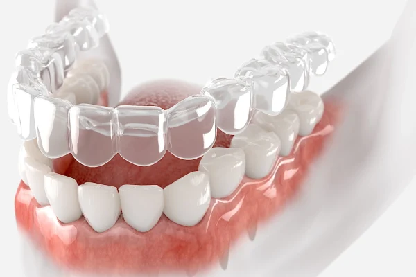 The-Difference-in-Straightening-Teeth-with-Invisalign®