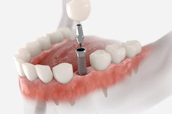 single implant - DENTIST NEAR YOU